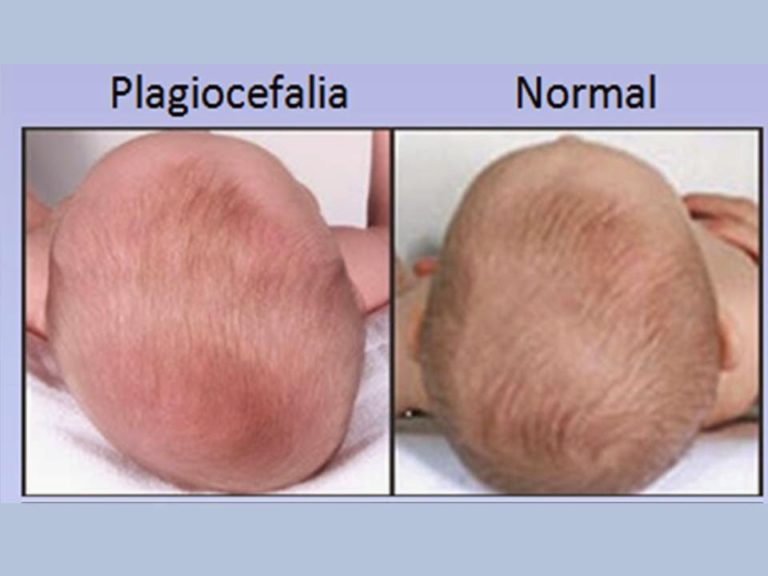 Plagiocefalia: prevención