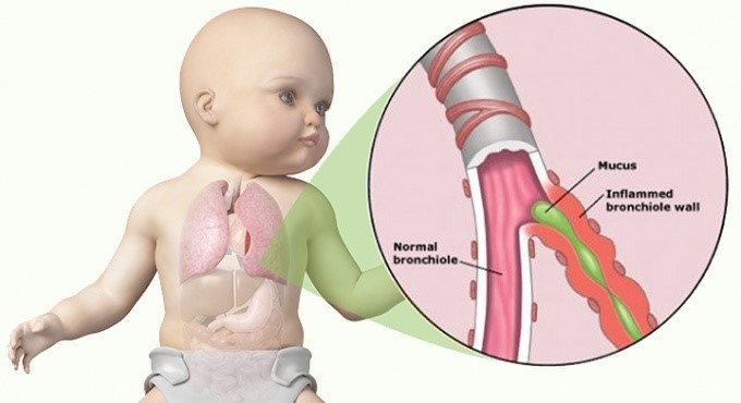 Bronquiolitis - Pediatria Salud