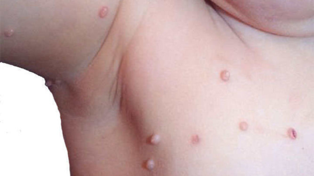 Molusco contagioso - Pediatria Salud