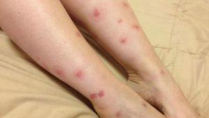 Picadura De Mosquito Pediatria Salud